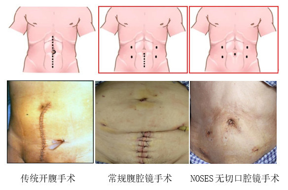 72岁结直肠癌患者术后肚皮找不到刀疤 竟因为