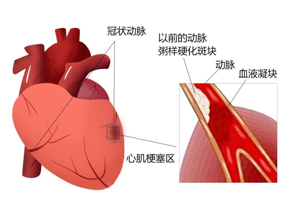 而急性心肌梗塞就是指 供应心脏自身细胞血液的冠状动脉狭窄堵塞,急性