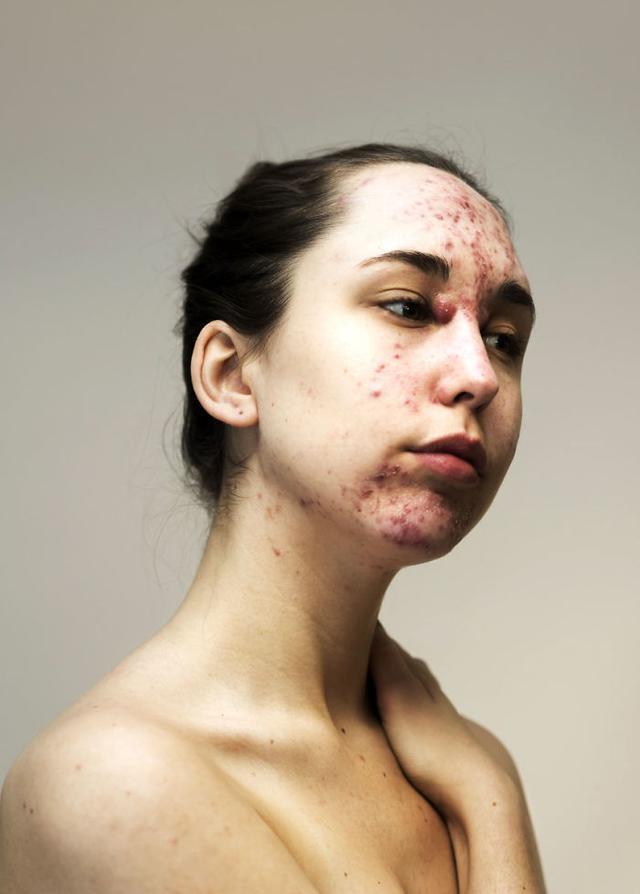 她们满脸吓人的痤疮,红斑,痘痘,却选择勇敢面对素颜