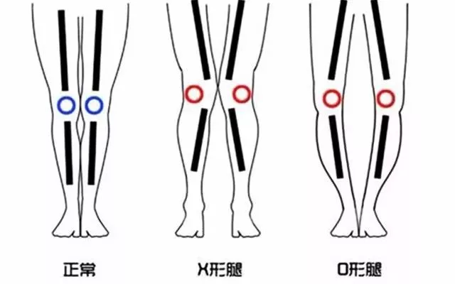 腿部膝关节变形还能矫治吗?-健康百科