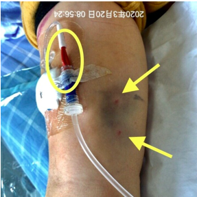 因治疗需要在右上臂头静脉置入picc导管.