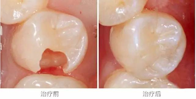 是牙本质层,可以去除坏掉的牙齿组织后,制备好窝洞,进行树脂补牙充填