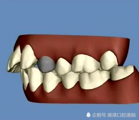 拔牙矫正会更加容易导致牙套脸吗?深圳箍牙