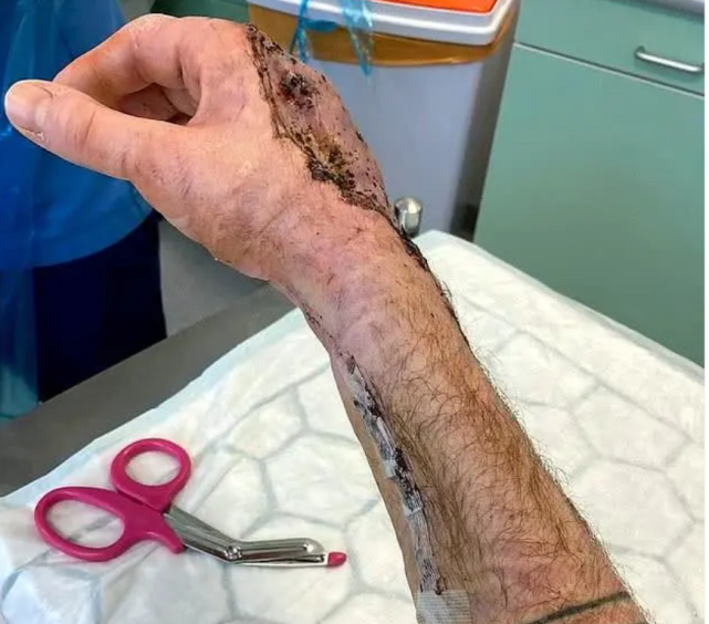 34岁男子手被割伤后染上恐怖食肉细菌,只能看着右手被