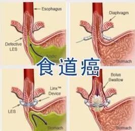 预防食管癌我们这样做