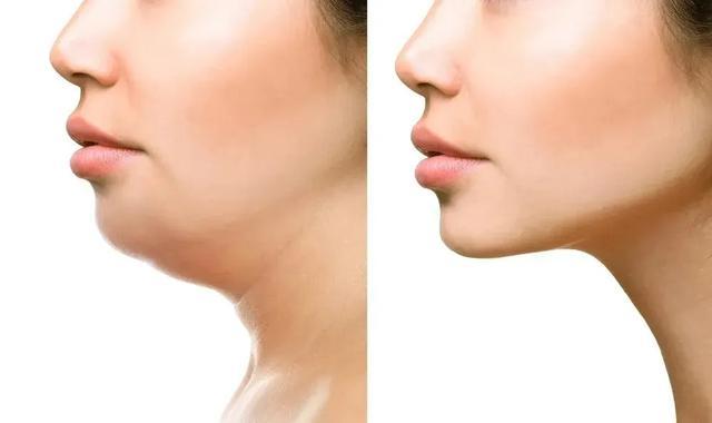 这种情况可以通过面部吸脂,超声溶脂等方式,获得清晰的下颌线.