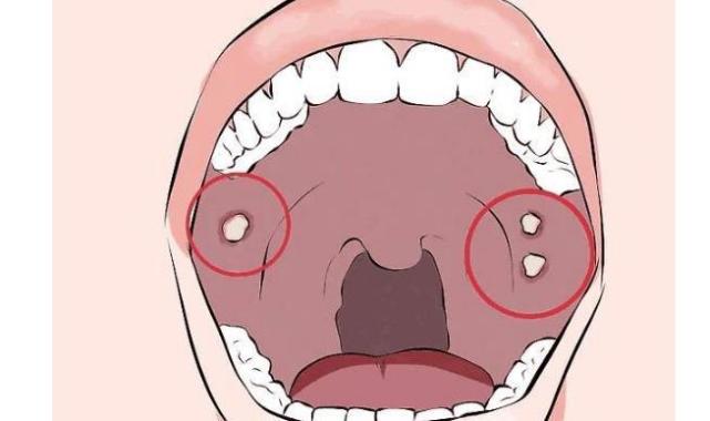 口腔出现这5个表现,口腔癌可能已经盯上你了,还请及时