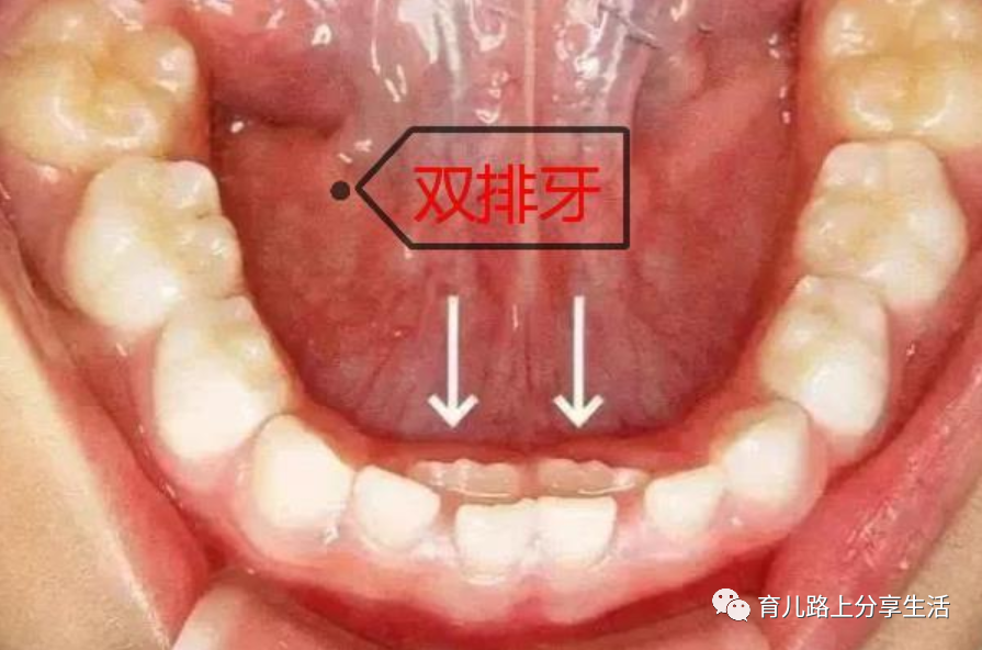 "乳牙迟早要换",错误观念差点伤到孩子牙神经,这些经验早收藏
