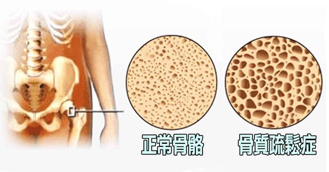 每天补钙，为什么还骨质疏松？这3个误区让你多年钙“白补”了
