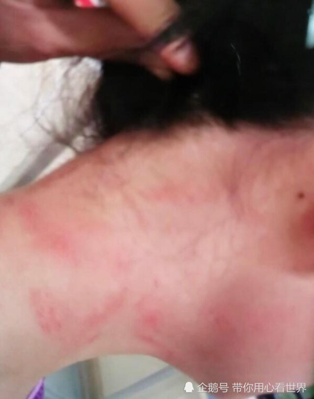 痛心:确诊的外国人撕咬一名广州女护士脸颊