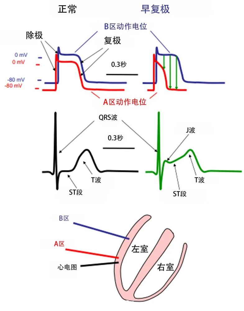 早复极心电图表现 qrs波终末顿挫(a)和切迹(b)≥0.