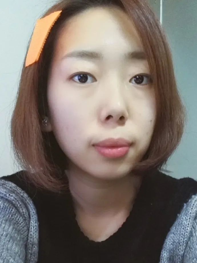 矫正前, 嘴巴突,嘴唇略厚, 自然状态下嘴唇闭合不自然.
