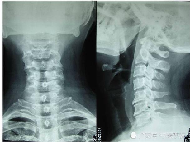 颈椎痛,拍片显示骨质增生,颈椎有轻微的骨质增生怎么办