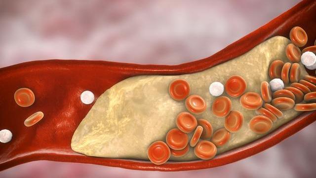 高血脂"罪魁祸首"揭晓,多数人爱不择口,忠告:难怪血脂一直高
