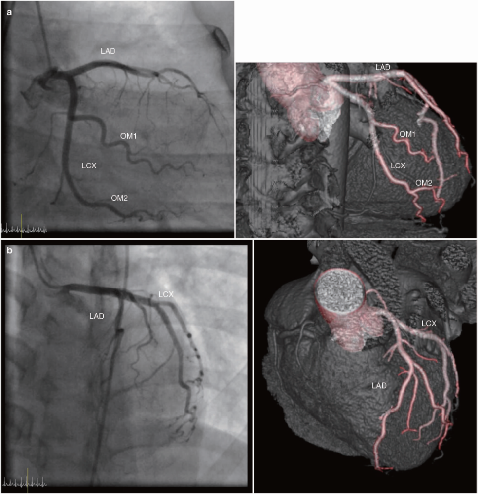 右冠状动脉远段:从锐缘支到心脏基底部. 血管造影与ct 图2.