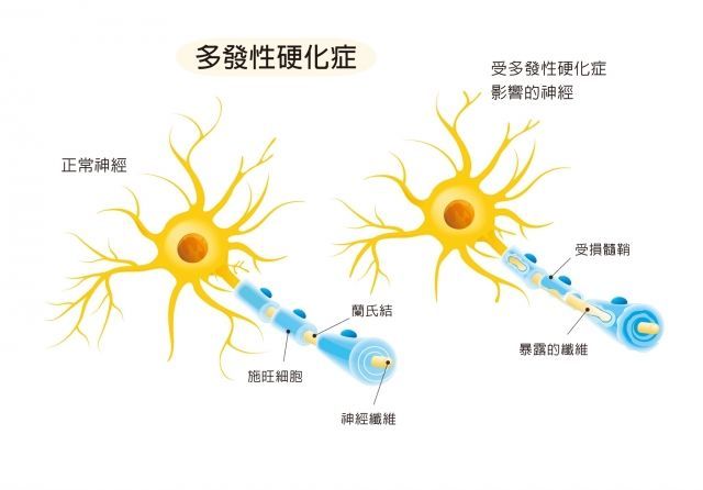 多发性硬化症(图源网络)