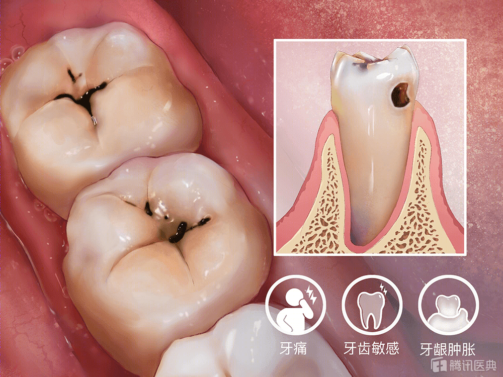 龋坏分为牙冠部位的牙釉质龋,牙根面的牙骨质龋(根面龋),以及深层的