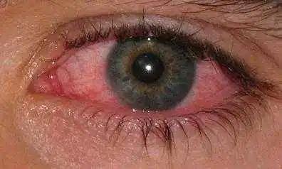 红眼病和虹膜炎有什么区别?