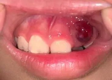 萌出性血肿/囊肿,表现为牙龈肿胀隆起,呈青紫色,看起来甚是吓人,常