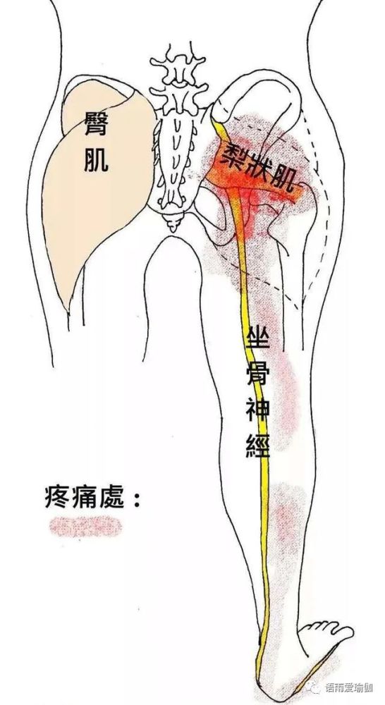 梨状肌可能是坐骨神经痛和下背部痛的根源一定要重视起来