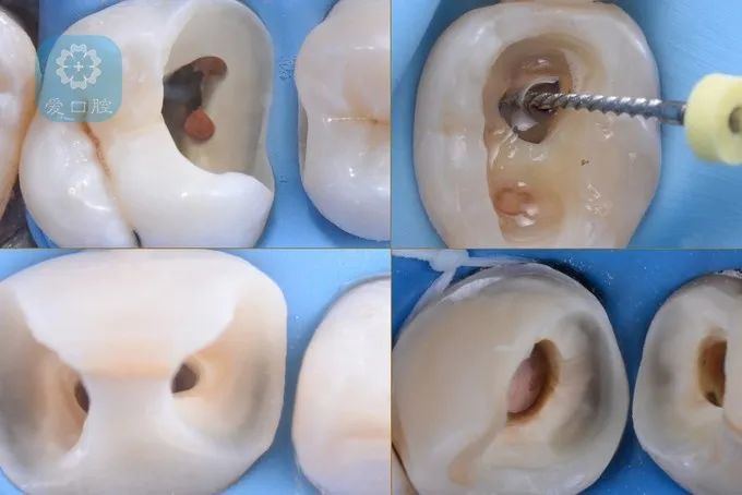 根管治疗后牙齿的微创修复