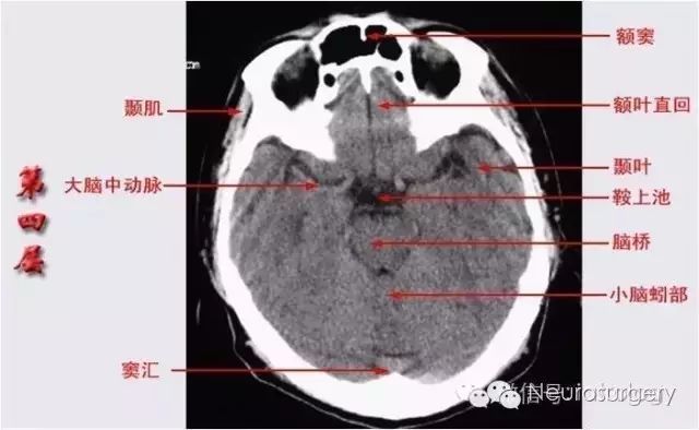 三室:三,四,侧脑室 四窦:额,筛,蝶窦乳突,上颌窦 分层轴位解剖 4,第四