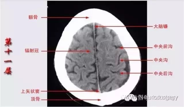 颅脑ct解剖口诀及彩色解剖图