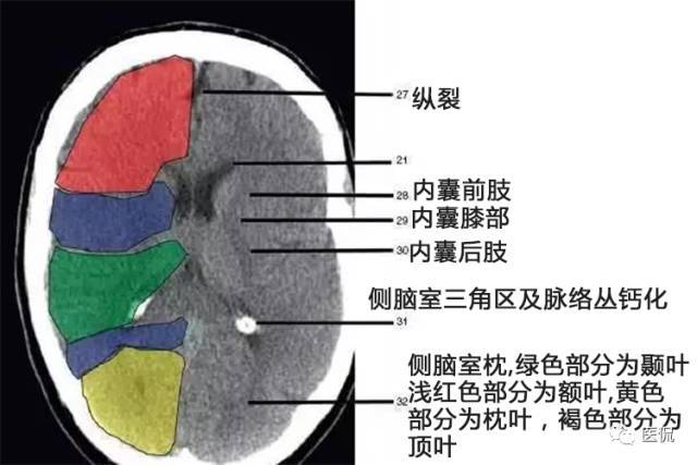 已收藏颅脑ct解剖口诀彩色解剖图