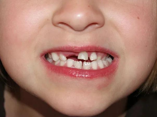 才2岁牙齿就变黑,罪魁祸首竟然是孩子最爱的它!