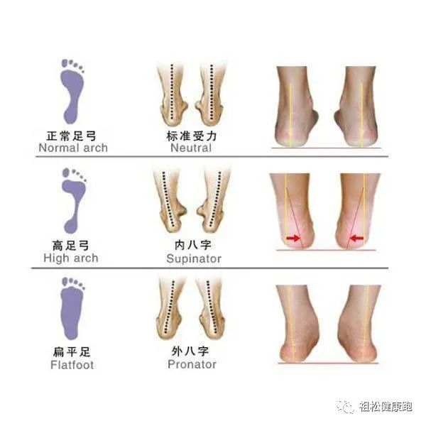 为什么会足弓塌陷爱跑步的你应该怎样避免一起来学习一下吧