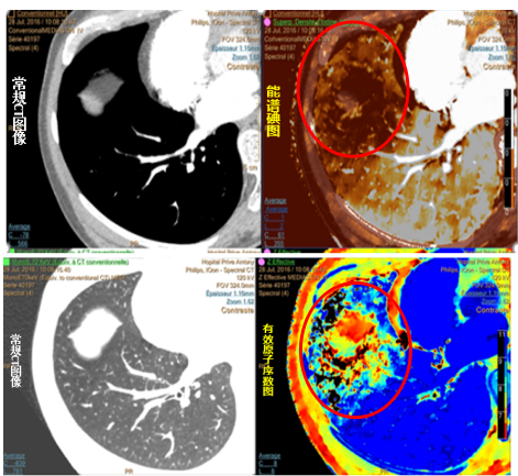 图13:iqon光谱ct扫描,发现肺内灌注减低