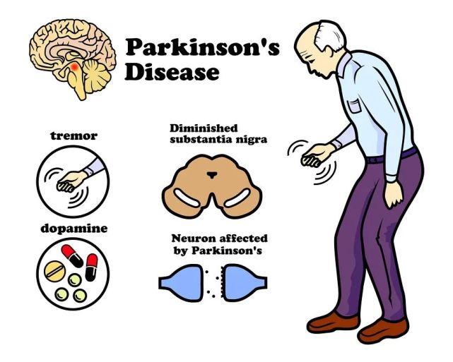 世界帕金森病日:益生菌可以减轻帕金森病患者运动功能的进行性恶化?