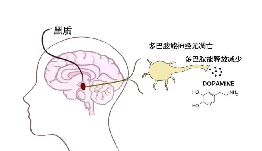 帕金森病的发病与多巴胺浓度关系非常密切,患者大脑纹状体区可利用的