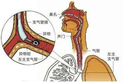 1岁女童误吸异物20多天……花生仁肺内"发芽",支气管内镜"拔除"!