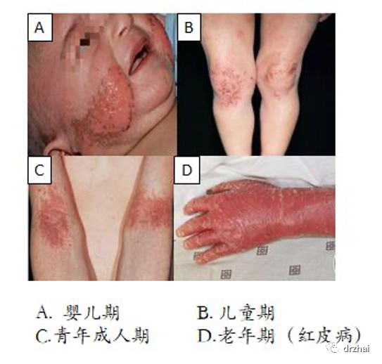 特应性皮炎,我们已经进行了很多年的研究,也有许多规范化的诊断标准