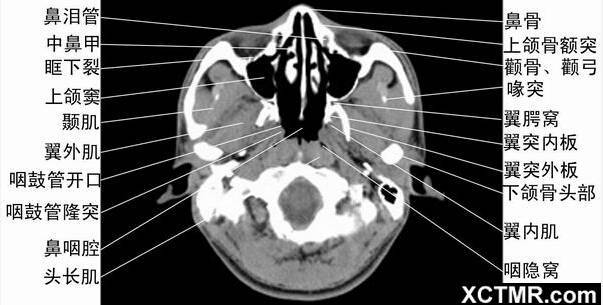 全面总结头颈五官ct解剖图