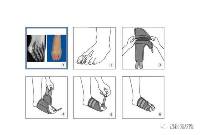 图文详解拇指外翻矫正治疗与运动康复训练