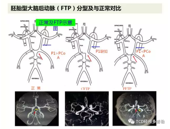 胚胎型大脑后动脉