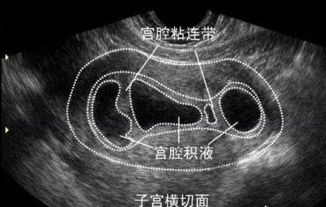 宫腔粘连还能怀孕吗?