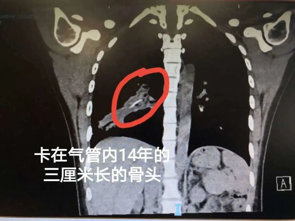 患者右下肺气管内竟然藏了一根异物,很可能是一根骨头或是鱼刺.