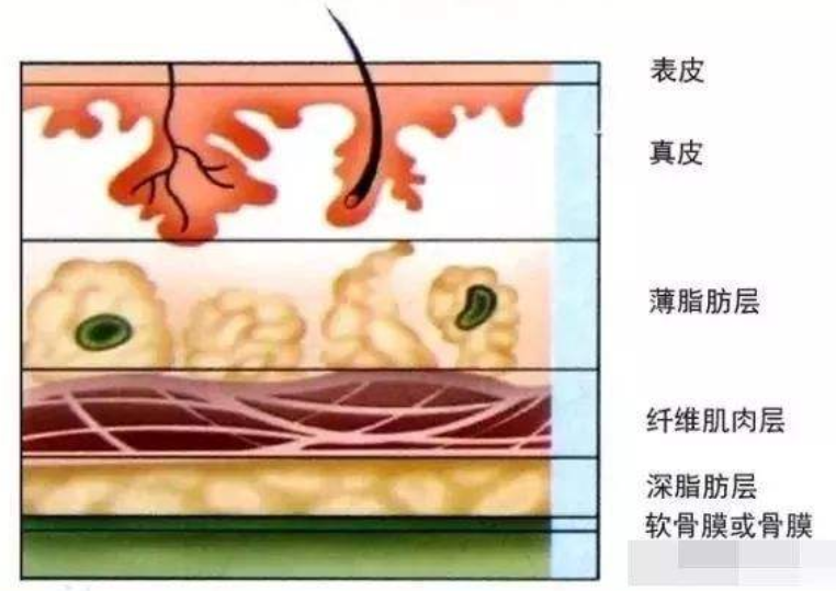 鼻根的皮肤软组织相对较疏松,注射后局部隆起明显;而鼻尖皮肤厚且致密