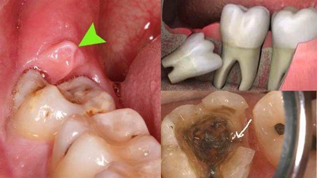 作为具有多年临床工作经验的口腔专业医师,我的回答是: 智齿是牙弓