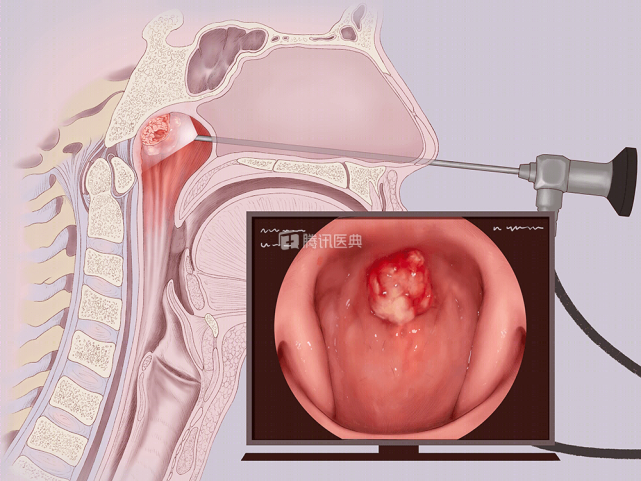 想筛查鼻咽癌,这3种鼻咽镜各有优缺点,合理选择很重要