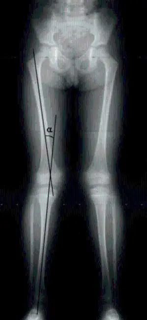 “X”型腿不好看？教你2步矫正，腿又细又直，好看