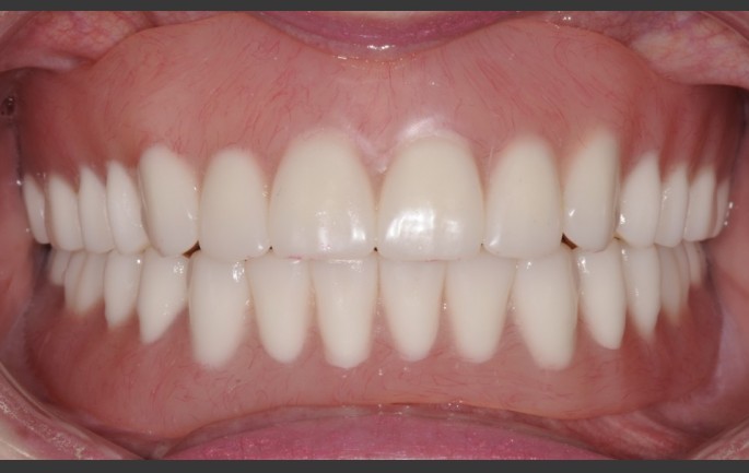 牙齿下岗:人到老年时,一望无牙,进食困难,怎么办?口腔医生给出3个方案