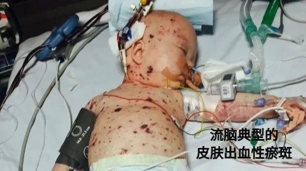 拜托:"流脑ac结合疫苗"这种疫苗,一定要给宝宝选自费接种