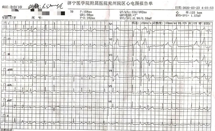 平均心率76次/分,最大心率121次/分,最慢心率56次/分,房性早搏6次