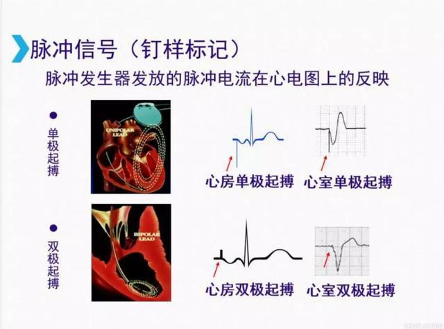 如何判断心脏起搏器是否工作正常?