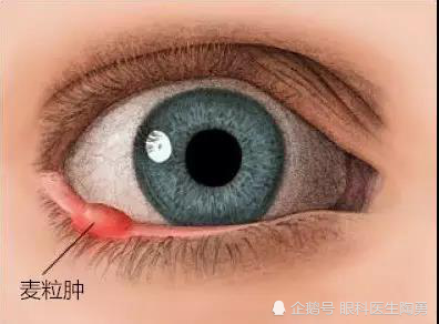 没有急性炎症的时候,它不红也不疼,有时翻开眼皮看,才能在内看到局部