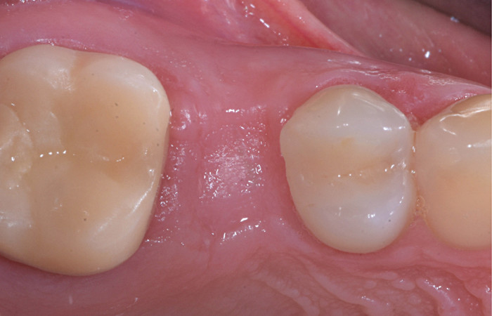 拔牙患者福利来了:拔牙前,后需要注意什么,口腔专业医师为你详细解说